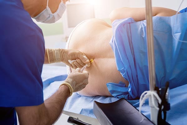epidural birth pregnancy 2